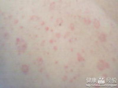 玫瑰糠疹可以吃哈密瓜,美味与健康的完美结合